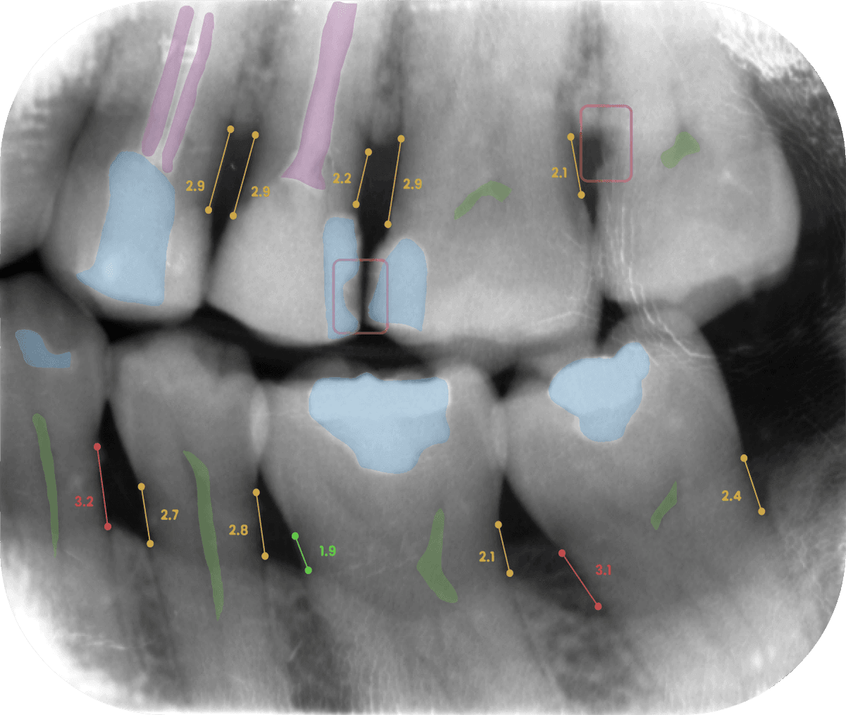 Periapical Image